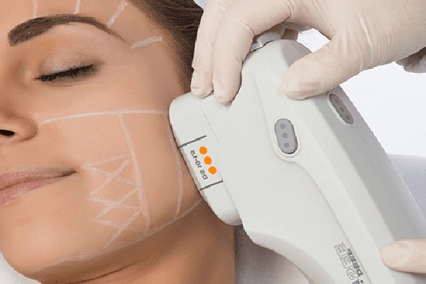 Ultherapy - Skin Therapies With Great Results